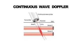 CONTINUOUS WAVE DOPPLER
 