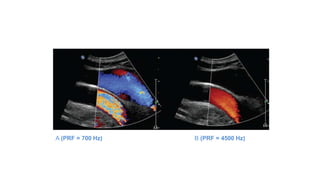 A (PRF = 700 Hz) B (PRF = 4500 Hz)
 