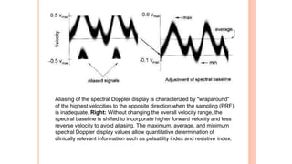 Aliasing of the spectral Doppler display is characterized by "wraparound“
of the highest velocities to the opposite direction when the sampling (PRF)
is inadequate. Right: Without changing the overall velocity range, the
spectral baseline is shifted to incorporate higher forward velocity and less
reverse velocity to avoid aliasing. The maximum, average, and minimum
spectral Doppler display values allow quantitative determination of
clinically relevant information such as pulsatility index and resistive index.
 