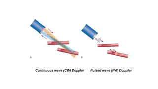 Continuous wave (CW) Doppler Pulsed wave (PW) Doppler
 