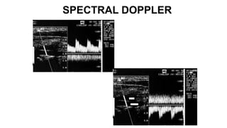 SPECTRAL DOPPLER
 