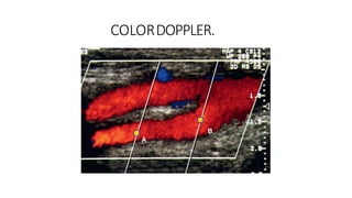 COLORDOPPLER.
B
A
 