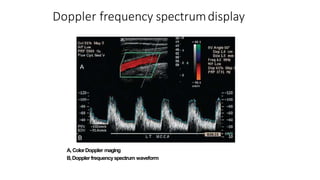 Doppler frequency spectrumdisplay
B
A, ColorDoppler maging
B,Doppler frequencyspectrum waveform
A
 