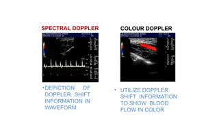 SPECTRAL DOPPLER
•DEPICTION OF
DOPPLER SHIFT
INFORMATION IN
WAVEFORM
COLOUR DOPPLER
• UTILIZE DOPPLER
SHIFT INFORMATION
TO SHOW BLOOD
FLOW IN COLOR
 