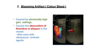 • Caused by abnormally high
gain settings.
• Causes the obscuration of
thrombus or plaques in the
vessel.
- Also seen with
ultrasound contrast
agents
2 . Blooming Artifact ( Colour Bleed )
 