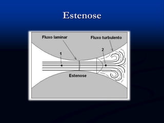 Estenose
 