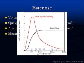 Estenose
 Volume de fluxo vs. Estenose
 Qualquer estenose altera o volume de fluxo?
 A estenose aumenta a velocidade. E o fluxo?
 Mecanismo de compensação
Adaptado de: Spencer MP. Stroke 10(3):326-330. 1979
 