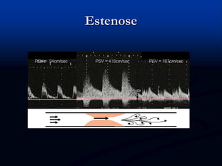 Estenose
 