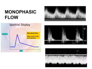 Doppler principle Evaluation of waveform .pptx