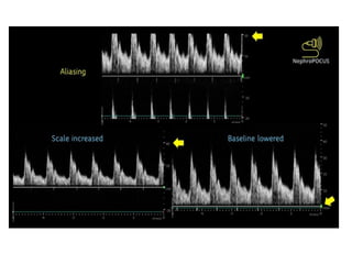 Doppler principle Evaluation of waveform .pptx