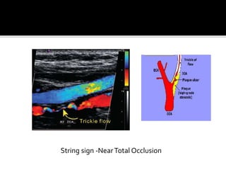 Doppler study general bases | PPTX