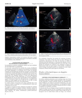 30-890-A-20 Doppler transcrânien Radiodiagnostic 
doppler transcrânien couleur, est surtout utile pour l’étude 
morphologique des anévrismes intracrâniens, des sténoses artérielles 
intracrâniennes et des collatérales [37, 38, 47]. 
UTILISATION DES PRODUITS 
DE CONTRASTE ULTRASONORES [8, 14, 15, 21, 35] 
Les produits de contraste actuellement utilisés sont tous constitués 
de microbulles libres ou encapsulées. 
Le Levovistt, seul produit de contraste de ce type actuellement 
commercialisé en France, se compose de microbulles d’air stabilisées 
par l’acide palmitique. Il se présente sous la forme de granules 
composés de microparticules de galactose associées à une très faible 
concentration d’acide palmitique. Les microbulles sont formées par 
la mise en suspension des granules de galactose dans de l’eau. Les 
microbulles d’un diamètre inférieur à 10 μm sont suffisamment 
petites pour passer le filtre pulmonaire. Le Levovistt augmente 
l’échogénicité du sang de façon reproductible et dose-dépendante, 
jusqu’à dissolution totale des microparticules. L’amplification 
obtenue en mode doppler est de l’ordre de 10 à 20 dB. La seule 
contre-indication du Levovistt est la galactosémie. 
Le nombre d’échecs d’insonation des artères cérébrales liés à une 
mauvaise fenêtre acoustique est considérablement réduit par 
l’utilisation du Levovistt. 
Par rapport à l’examen de base, l’injection de produit de contraste 
augmente le nombre de segments artériels visualisés, comme les 
branches périphériques des artères de la base, la portion distale du 
tronc basilaire, les artères cérébelleuses postéro-inférieures 
(fig 8A, B, 9A, B). 
Les modalités d’injection du produit de contraste évoluent. 
L’injection d’un bolus unique de toute la dose (300 mg) est 
aujourd’hui abandonnée, car l’effet de blooming et l’effet de 
saturation sont trop importants. La dose peut être injectée en trois à 
quatre petits bolus ou en infusion lente de 0,5 ou 1 mL/min, ce qui 
permet de minimiser les artefacts et de rallonger le temps de 
rehaussement utile du signal jusqu’à 15-20 minutes. L’utilisation 
d’une seringue électrique permet de combiner les deux types 
d’injection, infusion lente entrecoupée de microbolus. 
Études vélocimétriques en doppler 
transcrânien 
CRITÈRES VÉLOCIMÉTRIQUES NORMAUX [42, 43] 
Les artères cérébrales présentent un pic systolique aigu suivi d’une 
décroissance lente des vitesses laissant persister en fin de diastole 
un flux important. L’analyse spectrale montre une répartition des 
fortes brillances aux hautes et moyennes fréquences, avec une 
fenêtre sombre dans les basses fréquences. Les paramètres étudiés 
par le doppler transcrânien incluent la direction des flux, la vitesse 
circulatoire et la résistance vasculaire. 
La direction des flux est indiquée soit par la position du spectre par 
rapport à la ligne de base, les flux se dirigeant vers la sonde étant 
par convention positifs, soit par la couleur rouge ou bleu, les flux se 
dirigeant vers la sonde étant codés en rouge. Les vitesses 
6 Doppler transcrânien par voie temporale, mode puissance. Visualisation des si-phons 
carotidiens (flèches) et des artères cérébrales postérieures (têtes de flèches). 
7 Doppler transcrânien couleur par voie occipitale. Artères vertébrales (grosses flè-ches). 
Artères cérébelleuses postéro-inférieures (petites flèches). TB : tronc basilaire. 
8 Doppler transcrânien couleur par voie temporale, avant (A) et après (B) injection 
de Levovistt. Le rehaussement du signal après injection permet la visualisation com-plète 
du polygone deWillis. 
*A 
*B 
4 
 