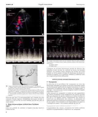 30-890-A-20 Doppler transcrânien Radiodiagnostic 
*A 
*B 
*C 
beaucoup plus liée à la microangiopathie qu’à l’atteinte des gros 
vaisseaux. Durant l’épreuve d’hyperhémie provoquée du bras, la 
vitesse et le sens du flux du tronc basilaire peuvent être plus ou 
moins altérés. 
¦ Étude du parenchyme cérébral dans l’ischémie 
aiguë [73] 
Grâce aux produits de contraste, le doppler n’est plus réservé à 
l’étude des flux. 
L’imagerie de seconde harmonique permet de détecter des 
anomalies focales de prise de contraste au niveau du territoire 
ischémié. Les premiers essais cliniques ont montré qu’il était 
possible, au lit du malade, d’évaluer la distribution du produit de 
contraste en rapport avec la perfusion cérébrale et d’effectuer ainsi 
une imagerie de perfusion ultrasonore. 
APPLICATIONS NEUROCHIRURGICALES 
¦ Vasospasme 
La détection et la surveillance du vasospasme au cours des 
hémorragies méningées par rupture d’anévrisme intracrânien restent 
une des principales applications du doppler transcrânien. Ce champ 
d’application est longtemps resté du domaine du doppler pulsé « à 
l’aveugle », mais des travaux récents soulignent l’intérêt du doppler 
transcrânien couleur [10, 57, 75]. 
L’effet sténosant du vasospasme se traduit par une augmentation 
des vitesses circulatoires et des modifications de l’analyse spectrale 
telles que dispersion du spectre, turbulences et même inversion de 
flux (fig 17). En doppler couleur, l’augmentation des vitesses se 
traduit par une désaturation des couleurs ; le phénomène de 
repliement spectral se traduit par la juxtaposition de couleurs claires, 
de sens opposé, et les turbulences sont responsables d’un aspect en 
« mosaïque de couleur » de la lumière artérielle (fig 18A, B). 
Vasospasme de l’artère cérébrale moyenne [2, 17, 41, 44, 60, 82] 
L’augmentation des vitesses circulatoires de l’artère cérébrale 
moyenne est proportionnelle à l’importance du vasospasme. 
14 Doppler transcrânien couleur avec injection de Levovistt, voie temporale. 
A. Doppler couleur. Zone d’accélération et de turbulences localisée sur le segment 
M1 de l’artère cérébrale moyenne gauche (flèche). 
B. Doppler pulsé. Vitesses très élevées (pic systolique supérieur à 300 cm/s) avec 
phénomène d’« aliasing » et dispersion du spectre. Les fortes brillances sont dé-placées 
vers le bas et la limite supérieure du spectre est mal définie et irrégulière. 
C. Artériographie carotidienne gauche, face. Sténose serrée de l’artère cérébrale 
moyenne. 
15 Doppler transcrânien couleur par voie temporale. Sténose du siphon carotidien. 
Vitesses élevées et turbulences dans le siphon carotidien en faveur d’une sténose supé-rieure 
à 50 %. 
A. Doppler couleur. 
B. Doppler pulsé. 
*A 
*B 
8 
 