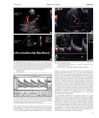 Radiodiagnostic Doppler transcrânien 30-890-A-20 
Une vitesse moyenne comprise entre 80 et 120 cm/s peut 
correspondre à un vasospasme discret, habituellement non détecté à 
l’artériographie. Lorsque les vélocités moyennes atteignent 
130 cm/s, l’artériographie montre habituellement un vasospasme 
*A 
*B 
modéré. En utilisant une valeur seuil de 130 cm/s, la spécificité du 
doppler transcrânien atteint 96 %, avec une valeur prédictive 
positive de 87 %. Une vitesse moyenne supérieure à 200 cm/s est en 
faveur d’un vasospasme sévère susceptible d’entraîner une ischémie 
cérébrale (tableau II). Presque tous les patients avec un vasospasme 
symptomatique ont une vitesse moyenne supérieure à 200 cm/s. En 
revanche, les patients chez qui la vitesse moyenne est supérieure à 
200 cm/s ne deviennent pas tous symptomatiques, en raison du 
développement d’une circulation collatérale adéquate. Plus que la 
valeur du pic systolique, c’est l’augmentation rapide des vitesses 
(supérieure à 50 cm/s en 24 heures) qui est de mauvais pronostic. 
Le rapport vitesse systolique de l’artère cérébrale moyenne/vitesse 
systolique de la carotide interne extracrânienne est aussi utilisé pour 
quantifier le vasospasme. Un rapport supérieur à 3 traduit un 
vasospasme sévère qui contre-indiquerait une intervention 
chirurgicale, selon Lindegaard [60]. 
Un vasospasme siégeant sur les branches distales de l’artère 
cérébrale moyenne peut passer complètement inaperçu au doppler 
transcrânien ; seul un vasospasme sévère avec des sténoses distales 
multiples peut retentir sur le flux de l’artère cérébrale moyenne 
proximale. Un vasospasme de l’artère cérébrale moyenne peut être 
sous-estimé s’il existe un vasospasme sévère du siphon carotidien 
réduisant globalement les vélocités des artères de la base du crâne. 
Les résultats du doppler transcrânien doivent être interprétés 
prudemment, car il faut garder à l’esprit que les vélocités sont 
dépendantes de la viscosité sanguine et que l’hématocrite est le 
principal facteur influençant la viscosité sanguine. 
16 Doppler transcrânien couleur, voie temporale. Homme de 35 ans ayant présenté 
une hémianopsie latérale homonyme gauche avec des signes d’ischémie dans 
le territoire de l’artère cérébrale postérieure au scanner. Du côté droit, bonne visualisa-tion 
de l’artère cérébrale moyenne et de l’artère cérébrale antérieure avec un signal cou-leur 
de bonne qualité. L’artère cérébrale postérieure est codée en rouge sombre (vitesses 
lentes) et son signal en doppler pulsé est anormal, microvolté et résistant. Ces anoma-lies 
confirment une occlusion distale de l’artère cérébrale postérieure. 
A. Doppler couleur. 
B. Doppler pulsé. 
*A 
*B 
17 Doppler transcrânien. Analyse spectrale du signal doppler, à une profondeur 
de 60 mm. Vasospasme de l’artère cérébrale moyenne. Vitesse systolique maximale 
de 241 cm/s et vitesse moyenne de 157 cm/s. Dispersion du spectre avec comblement 
de la fenêtre sombre, les fortes brillances prédominant à la partie basse du spectre. 
La composante négative traduit des phénomènes tourbillonnaires. 
18 Doppler transcrânien couleur. Vasospasme de l’artère cérébrale moyenne dans les 
suites d’une hémorragie méningée. 
A. Doppler couleur : aspect multicoloré, en « mosaïque », traduisant des vitesses 
élevées et un flux turbulent. 
B. Doppler pulsé : le pic systolique maximal est supérieur à 250 cm/s. 
9 
 