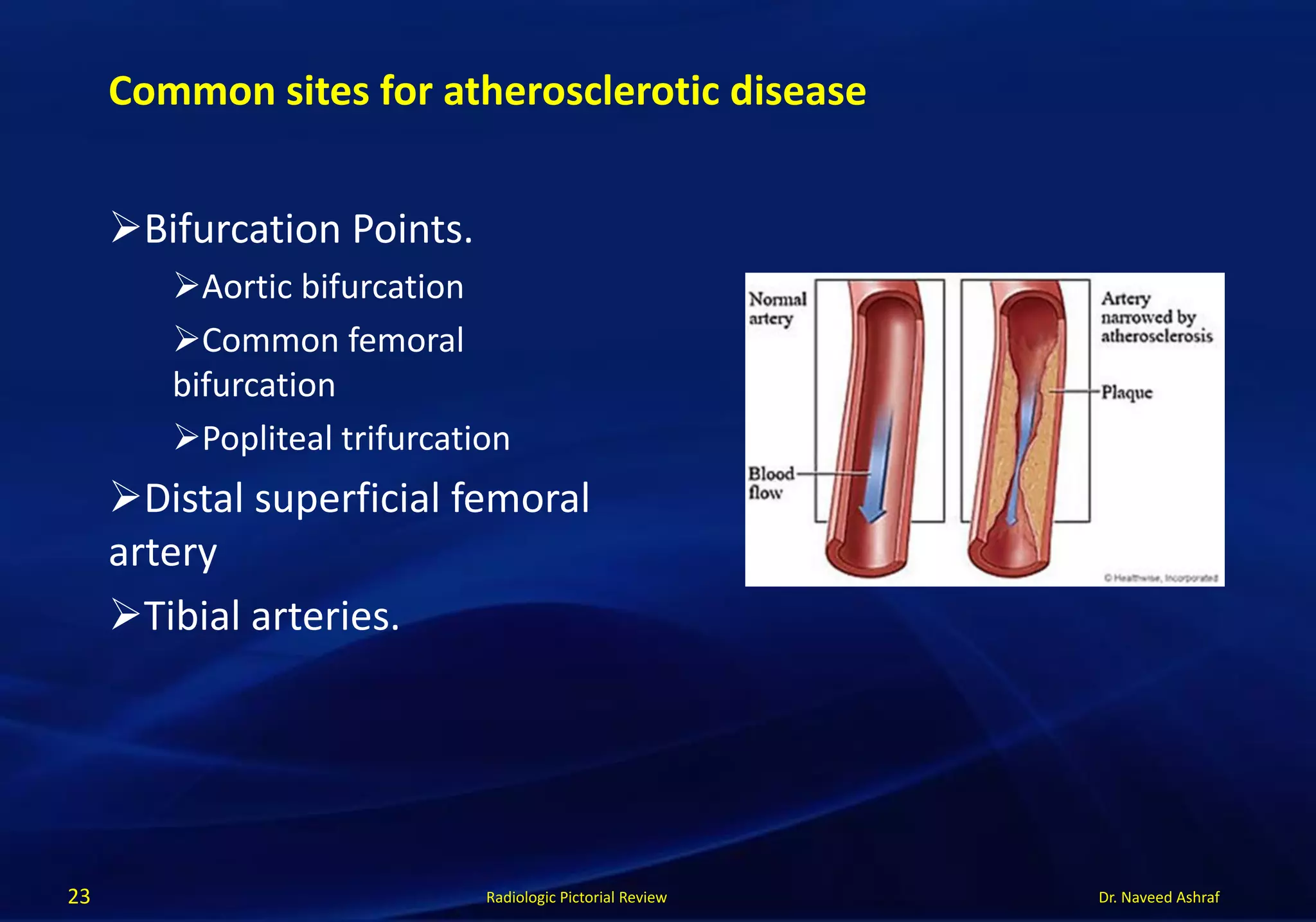 Dr. Naveed AshrafRadiologic Pictorial Review
Bifurcation Points.
Aortic bifurcation
Common femoral
bifurcation
Popliteal trifurcation
Distal superficial femoral
artery
Tibial arteries.
23
Common sites for atherosclerotic disease
 