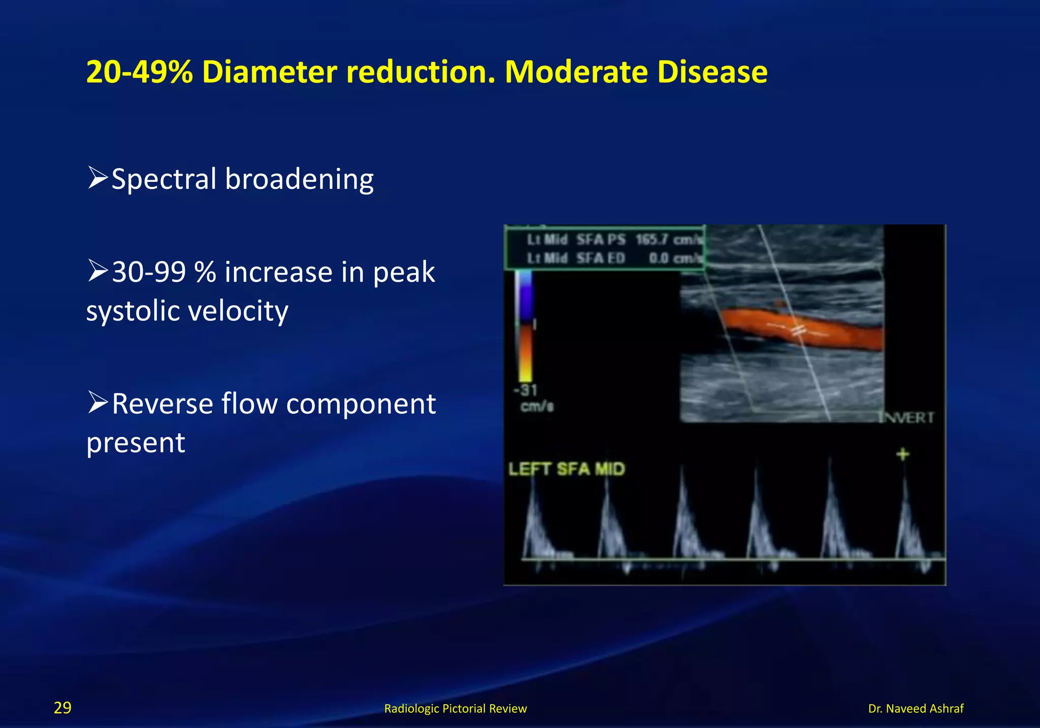 Dr. Naveed AshrafRadiologic Pictorial Review
Spectral broadening
30-99 % increase in peak
systolic velocity
Reverse flow component
present
29
20-49% Diameter reduction. Moderate Disease
 