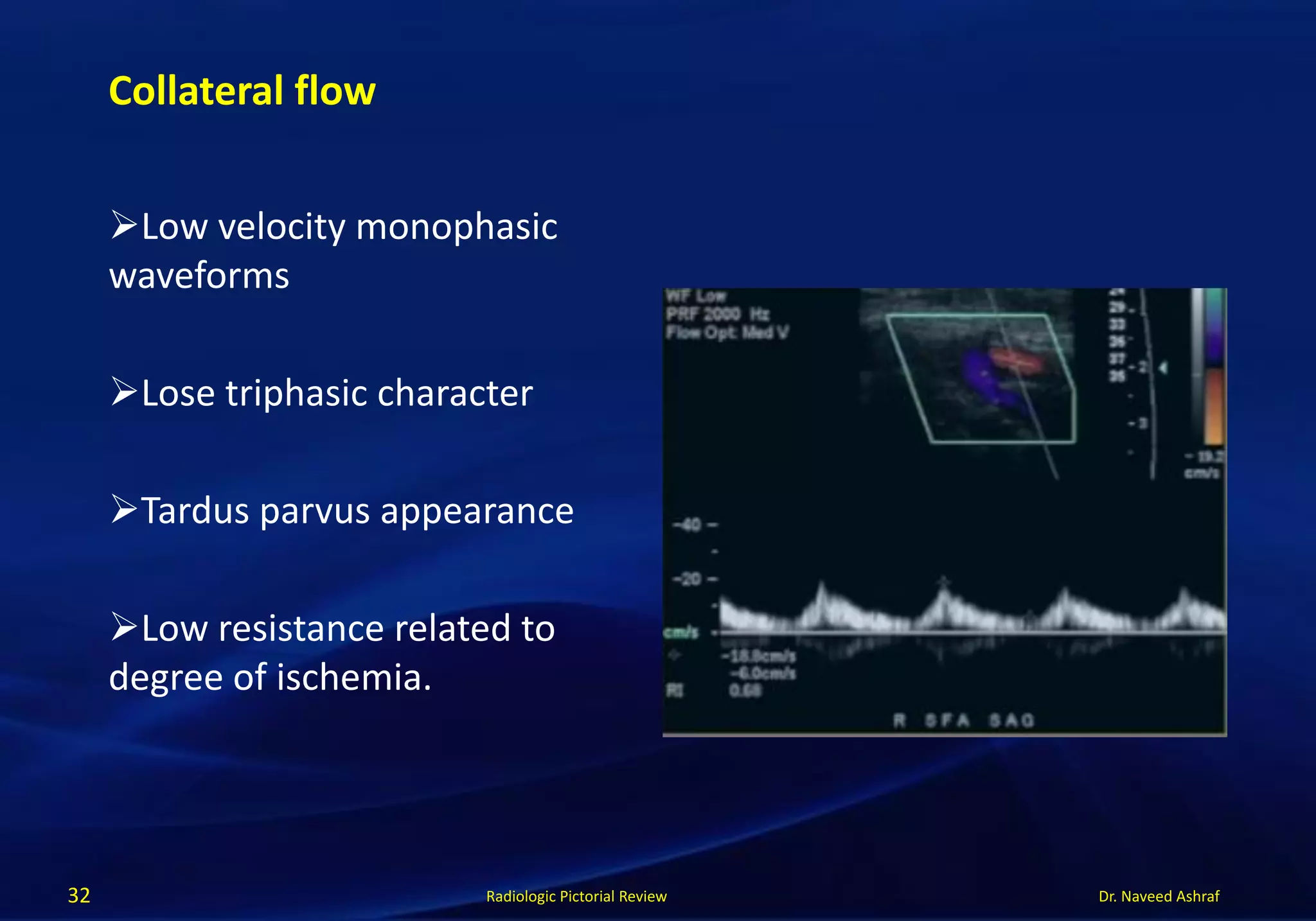 Dr. Naveed AshrafRadiologic Pictorial Review
Low velocity monophasic
waveforms
Lose triphasic character
Tardus parvus appearance
Low resistance related to
degree of ischemia.
32
Collateral flow
 