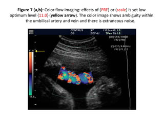 Figure 7 (a,b): Color flow imaging: effects of (PRF) or (scale) is set low
optimum level {11.0} (yellow arrow). The color image shows ambiguity within
the umbilical artery and vein and there is extraneous noise.
 
