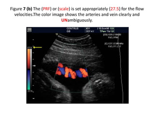 Figure 7 (b) The (PRF) or (scale) is set appropriately {27.5} for the flow
velocities.The color image shows the arteries and vein clearly and
UNambiguously.
 
