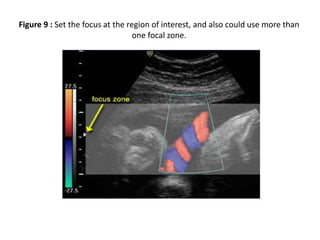 Figure 9 : Set the focus at the region of interest, and also could use more than
one focal zone.
 
