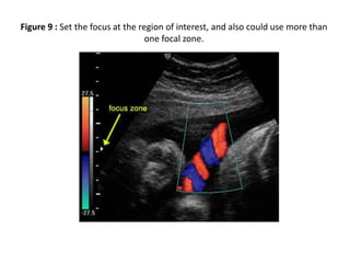Figure 9 : Set the focus at the region of interest, and also could use more than
one focal zone.
 