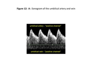 Figure 12: A : Sonogram of the umbilical artery and vein
 