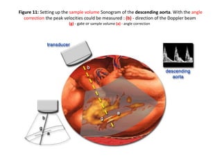 Figure 11: Setting up the sample volume Sonogram of the descending aorta. With the angle
correction the peak velocities could be measured : (b) - direction of the Doppler beam
(g) - gate or sample volume (a) - angle correction
 