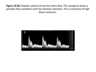 Figure 10 (b): Doppler spectra of uterine artery flow .The sonogram shows a
pulsatile flow waveform with low diastolic velocities. This is indicative of high
distal resistance.
 