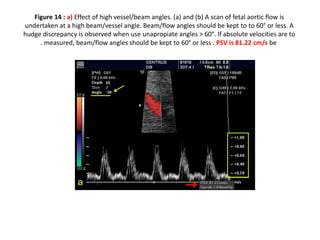Figure 14 : a) Effect of high vessel/beam angles. (a) and (b) A scan of fetal aortic flow is
undertaken at a high beam/vessel angle. Beam/flow angles should be kept to to 60° or less. A
hudge discrepancy is observed when use unapropiate angles > 60°. If absolute velocities are to
be
measured, beam/flow angles should be kept to 60° or less . PSV is 81.22 cm/s
.
 
