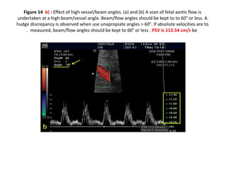 Figure 14 b) : Effect of high vessel/beam angles. (a) and (b) A scan of fetal aortic flow is
undertaken at a high beam/vessel angle. Beam/flow angles should be kept to to 60° or less. A
hudge discrepancy is observed when use unapropiate angles > 60°. If absolute velocities are to
be
measured, beam/flow angles should be kept to 60° or less . PSV is 113.54 cm/s
.
 