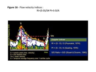 Figure 16 - Flow velocity indices :
RI=(S-D)/S# PI=S-D/A
 