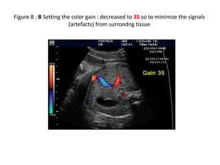 Figure 8 : B Setting the color gain : decreased to 35 so to minimize the signals
(artefacts) from surrondng tissue
 
