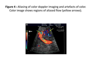 Figure 4 : Aliasing of color doppler imaging and artefacts of color.
Color image shows regions of aliased flow (yellow arrows).
 