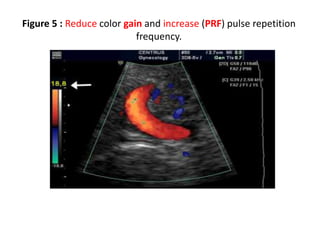Figure 5 : Reduce color gain and increase (PRF) pulse repetition
frequency.
 