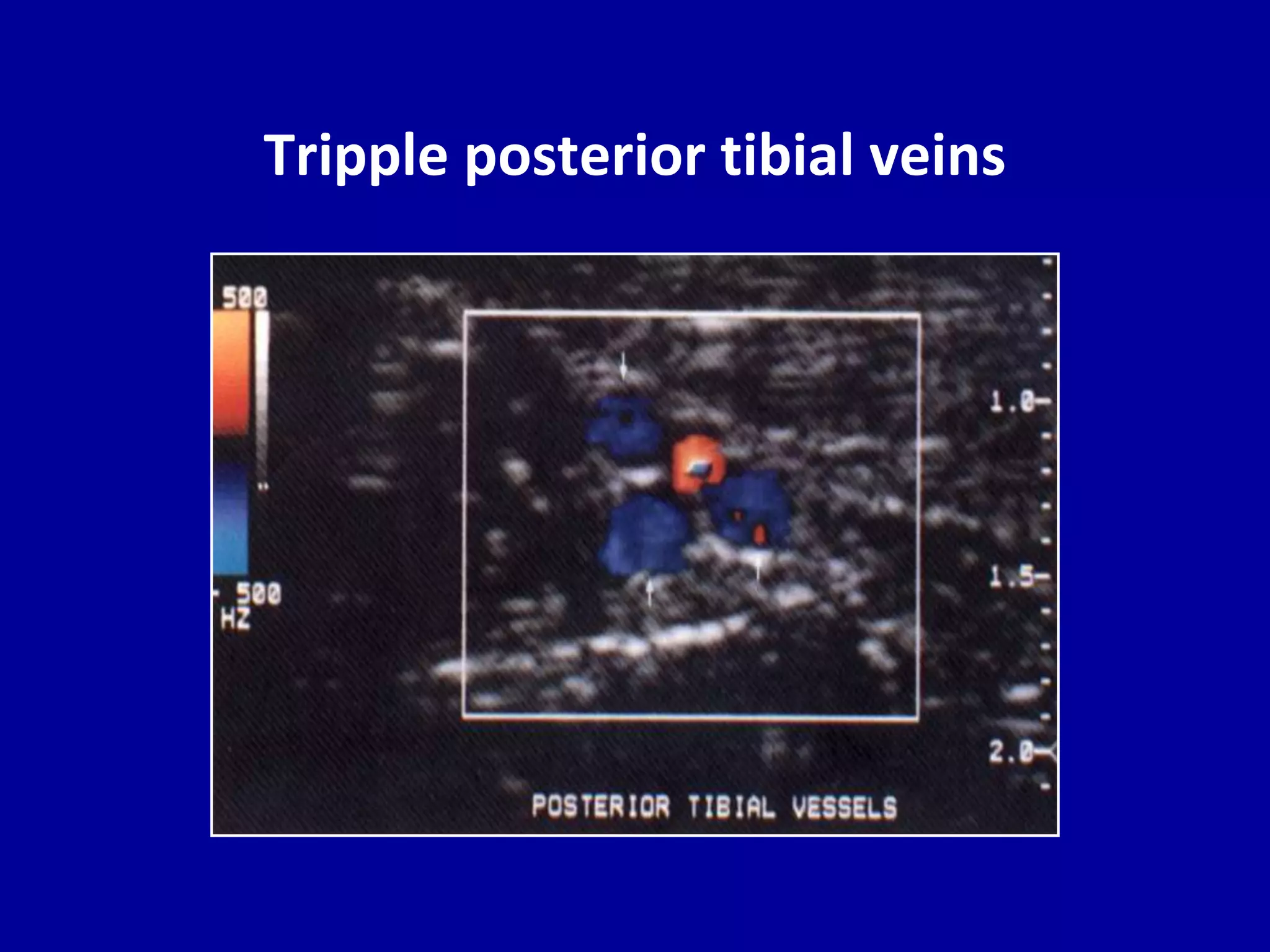 Doppler ultrasound in deep vein thrombosis | PPTX