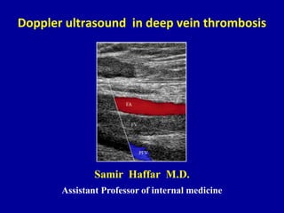 Doppler ultrasound in deep vein thrombosis
Samir Haffar M.D.
Assistant Professor of internal medicine
 