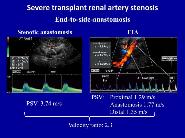 Doppler ultrasound in transplant renal artery stenosis | PPT