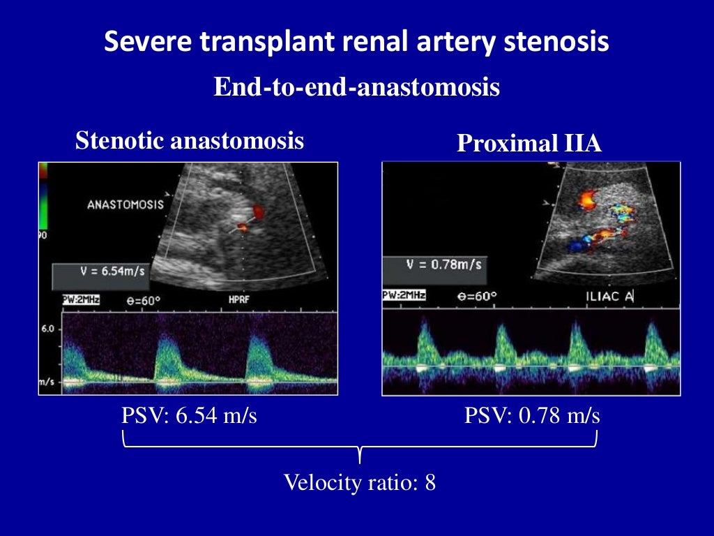 Doppler ultrasound in transplant renal artery stenosis