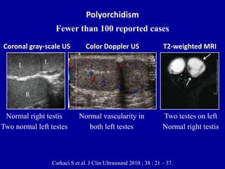Doppler ultrasound of acute scrotum | PPTX