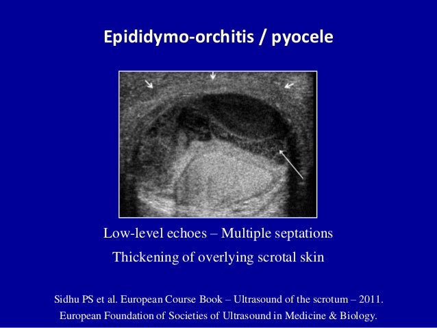 Doppler ultrasound of acute scrotum