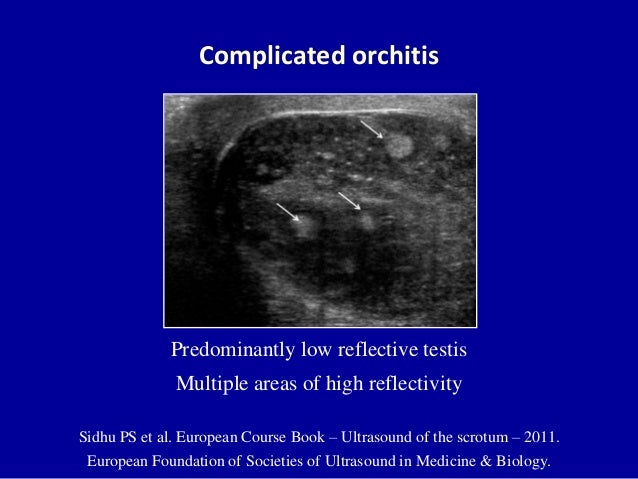 Doppler ultrasound of acute scrotum