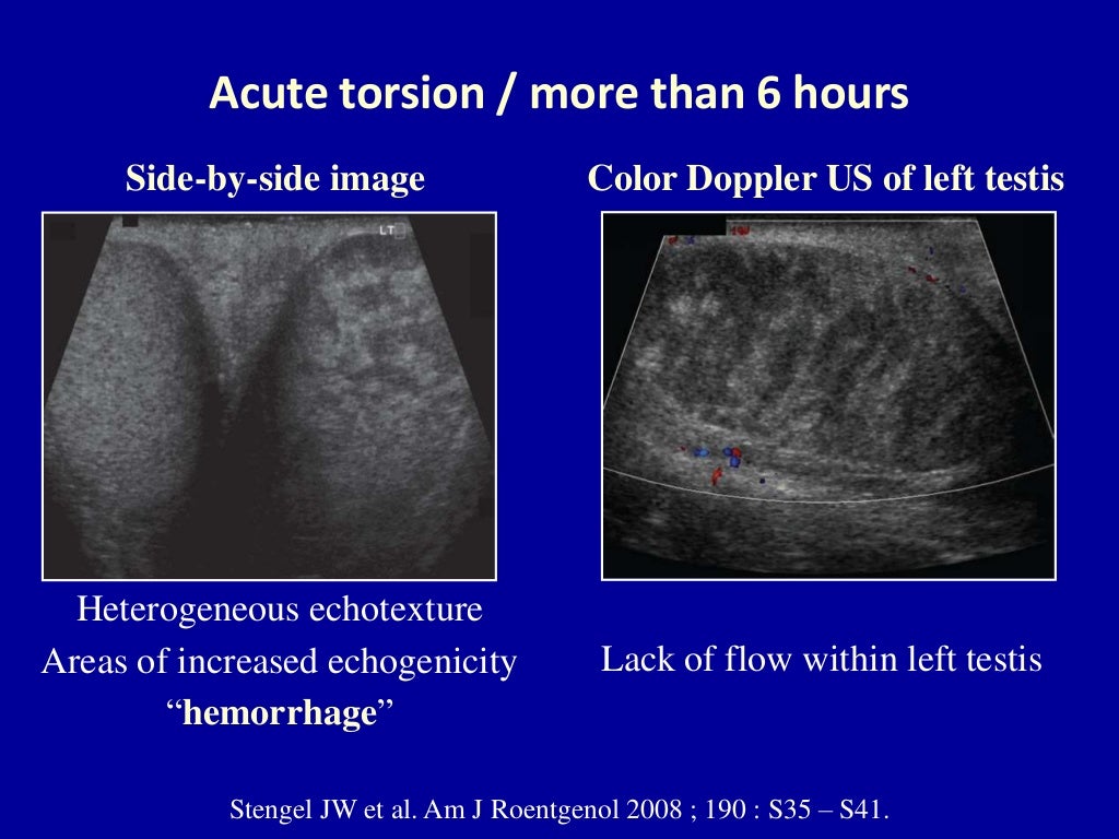 Doppler ultrasound of acute scrotum