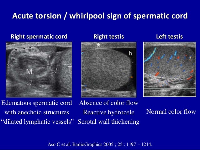 ãColor Doppler testicular torsionãã®ç»åæ¤ç´¢çµæ