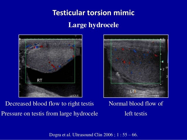 testicular ultrasound