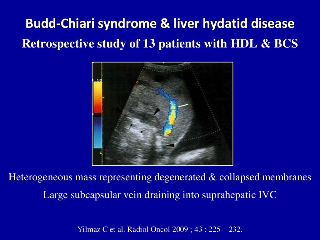 Doppler ultrasound of Budd Chiari syndrome & SOS
