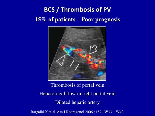 Doppler ultrasound of Budd Chiari syndrome & SOS liver cell diagram 