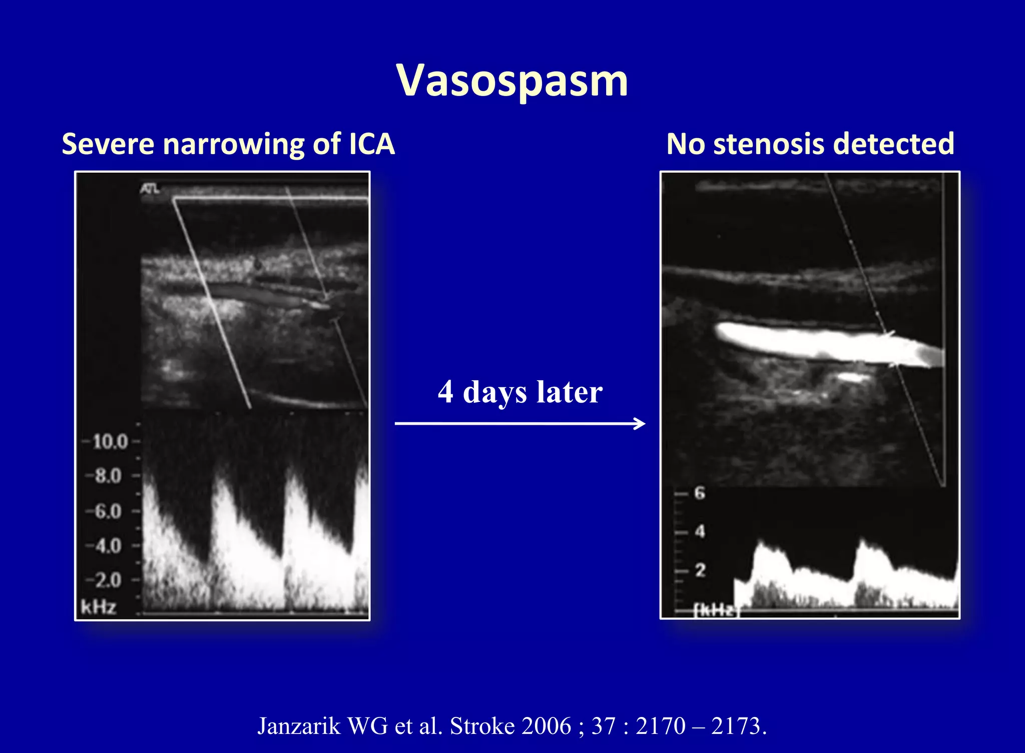 Vasospasm
Janzarik WG et al. Stroke 2006 ; 37 : 2170 – 2173.
Severe narrowing of ICA No stenosis detected
4 days later
 
