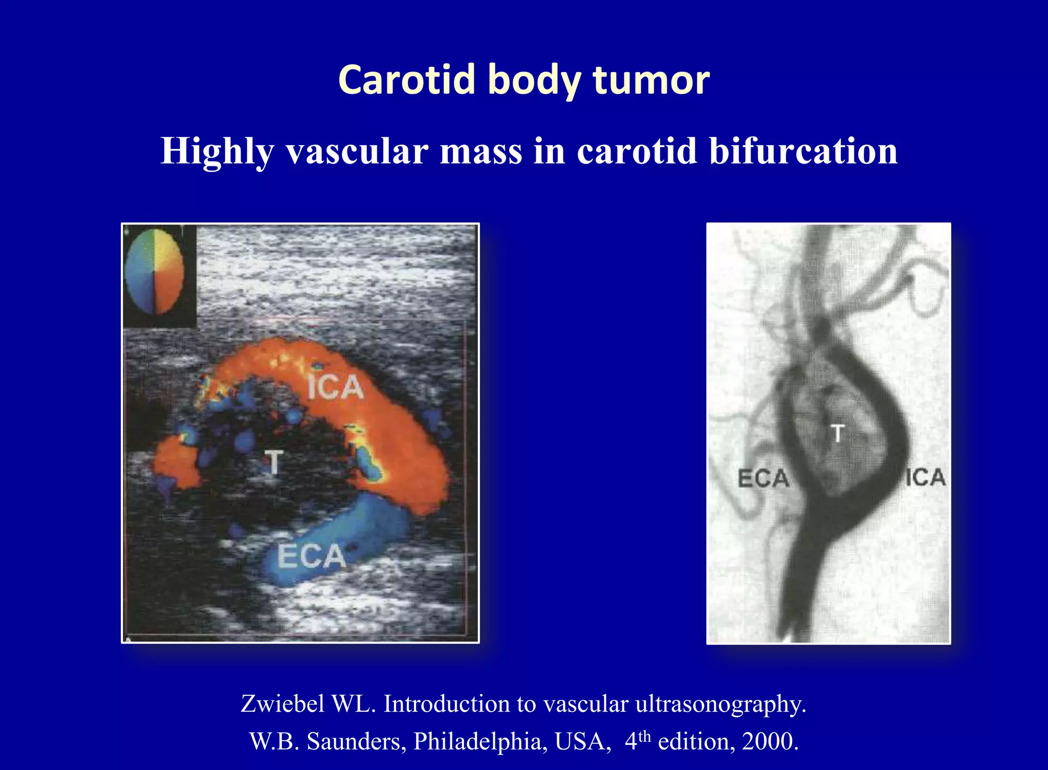 Carotid body tumor
Highly vascular mass in carotid bifurcation
Zwiebel WL. Introduction to vascular ultrasonography.
W.B. Saunders, Philadelphia, USA, 4th edition, 2000.
 