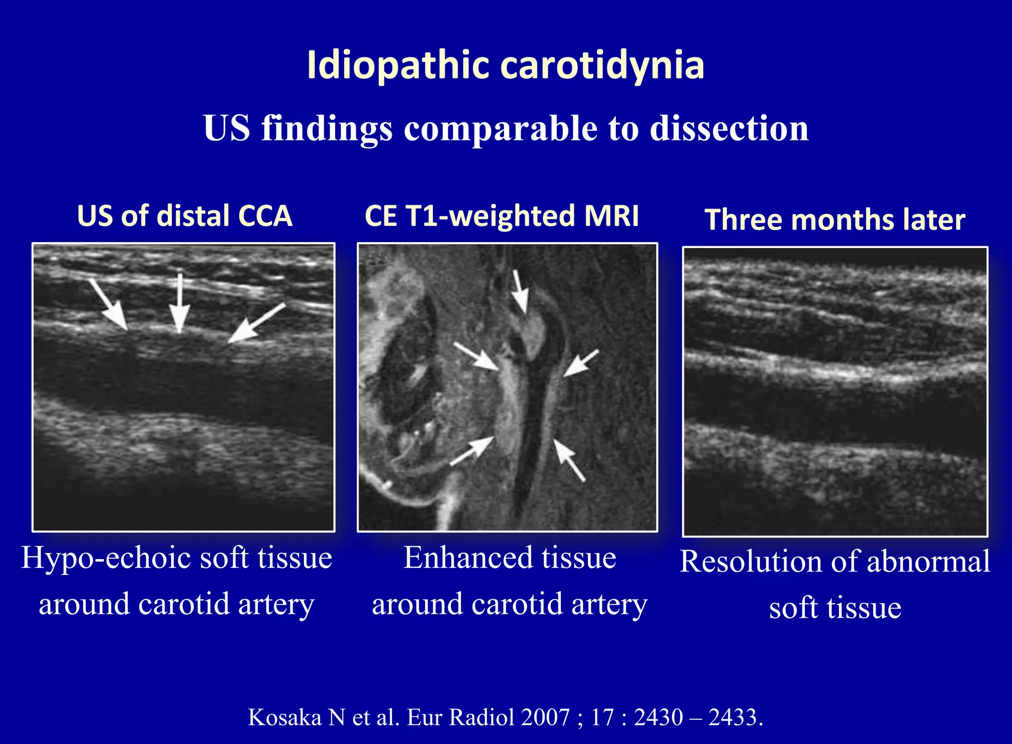 Idiopathic carotidynia
US findings comparable to dissection
Kosaka N et al. Eur Radiol 2007 ; 17 : 2430 – 2433.
Enhanced tissue
around carotid artery
CE T1-weighted MRIUS of distal CCA
Hypo-echoic soft tissue
around carotid artery
Three months later
Resolution of abnormal
soft tissue
 