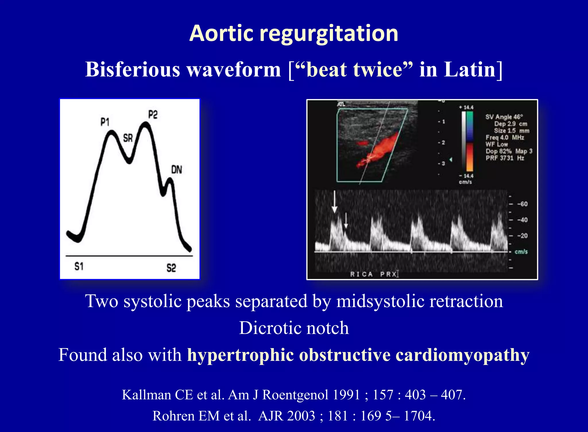 Aortic regurgitation
Bisferious waveform [“beat twice” in Latin]
Kallman CE et al. Am J Roentgenol 1991 ; 157 : 403 – 407.
Rohren EM et al. AJR 2003 ; 181 : 169 5– 1704.
Two systolic peaks separated by midsystolic retraction
Dicrotic notch
Found also with hypertrophic obstructive cardiomyopathy
 